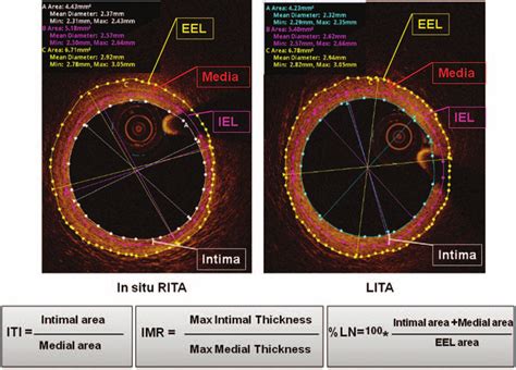 mobile intimal media thickness testing|intima media thickness.